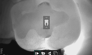 Tooth highlighted by cavity detection system
